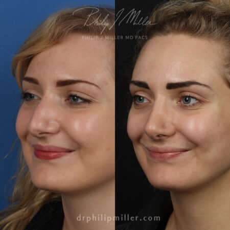 Rhinoplasty to adjust the nasal bridge and tip of a female patient by Dr. Miller