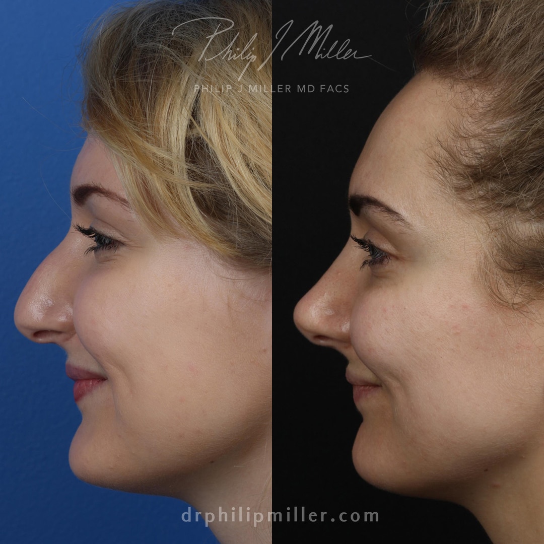 Rhinoplasty to adjust the nasal bridge and tip of a female patient by Dr. Miller. Surgery straightens bridge and upturns nasal tip to improve facial profile.