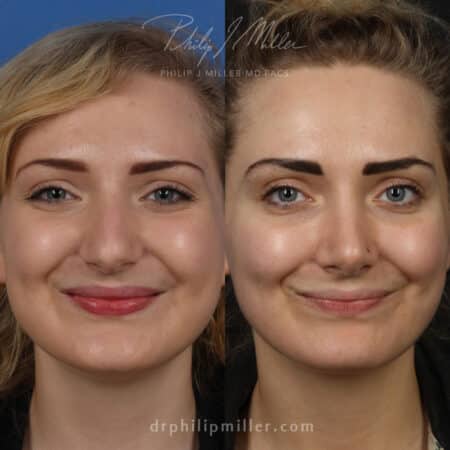 Rhinoplasty to adjust the nasal bridge and tip of a female patient by Dr. Miller