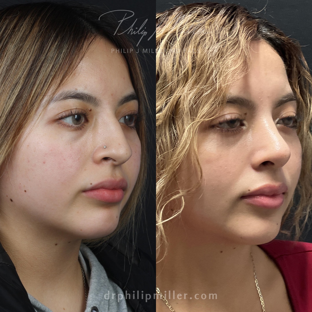 Rhinoplasty to improve nasal bridge and rotate tip of a female patient by Dr. Miller, Surgery straightens bridge and lifts nasal tip to improve patient profile.