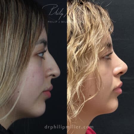 Rhinoplasty to improve nasal bridge and rotate tip of a female patient by Dr. Miller