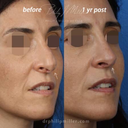 Rhinoplasty to improve nasal tip, profile of a female patient by Dr. Miller