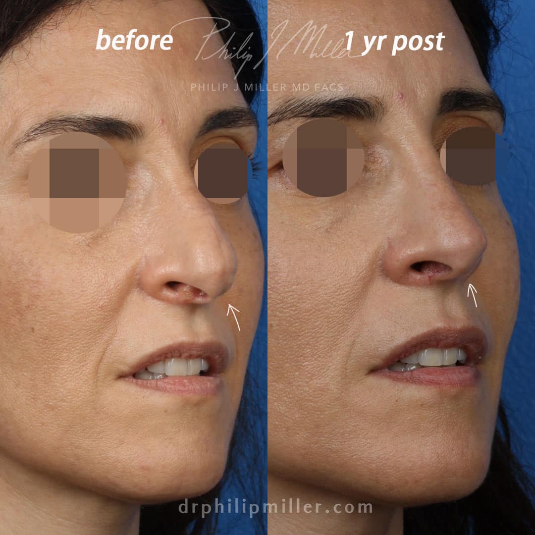 Rhinoplasty to improve nasal tip, profile of a female patient by Dr. Miller. Surgery lifts drooping tip to improve nasal shape and profile.