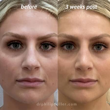 Rhinoplasty to refine nasal tip of a female patient by Dr. Miller