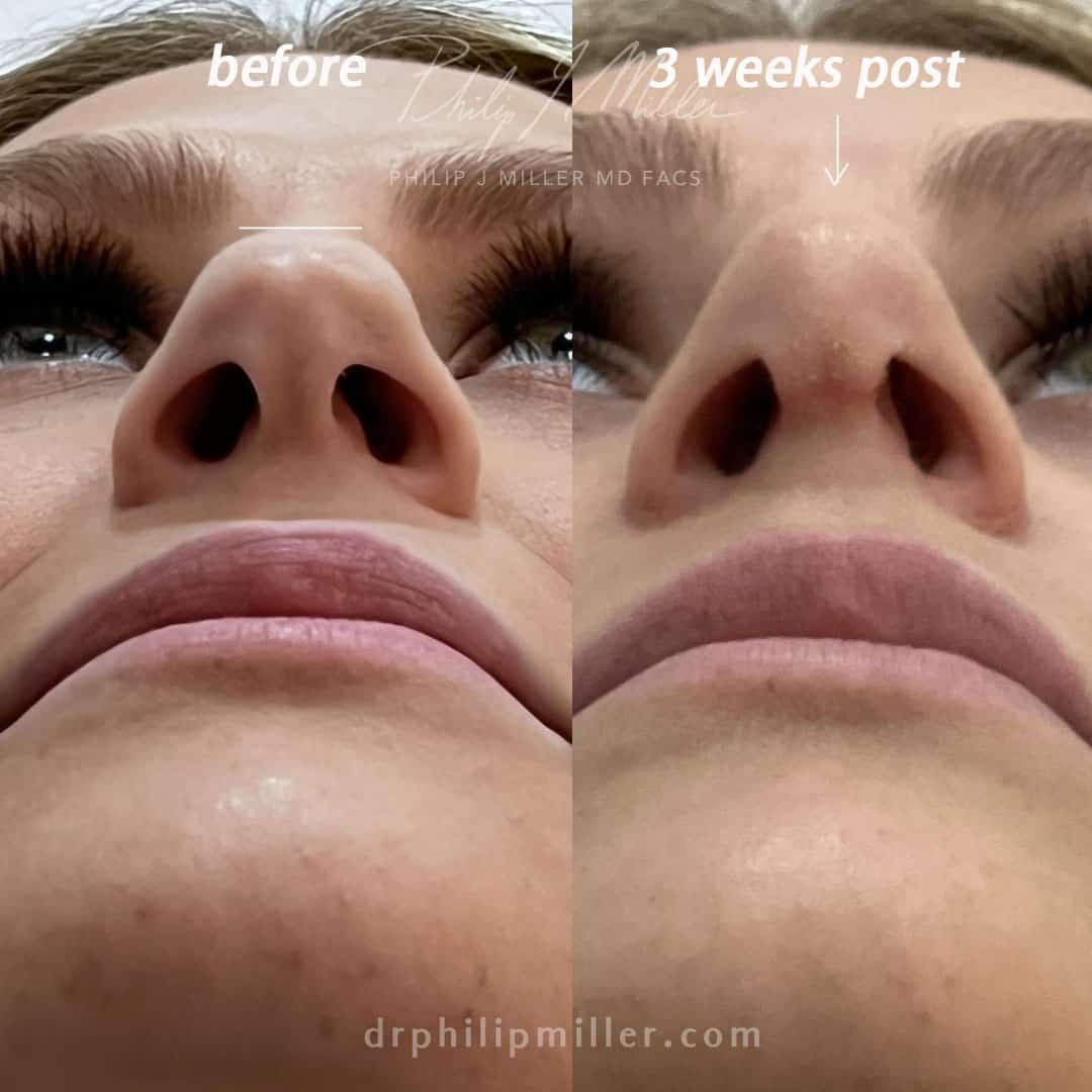 Rhinoplasty to refine nasal tip of a female patient by Dr. Miller. After surgery, tip is less flat and shape is improved.