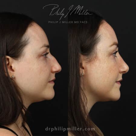 Rhinoplasty to remove bump and straighten nasal bridge of female patient by Dr. Miller