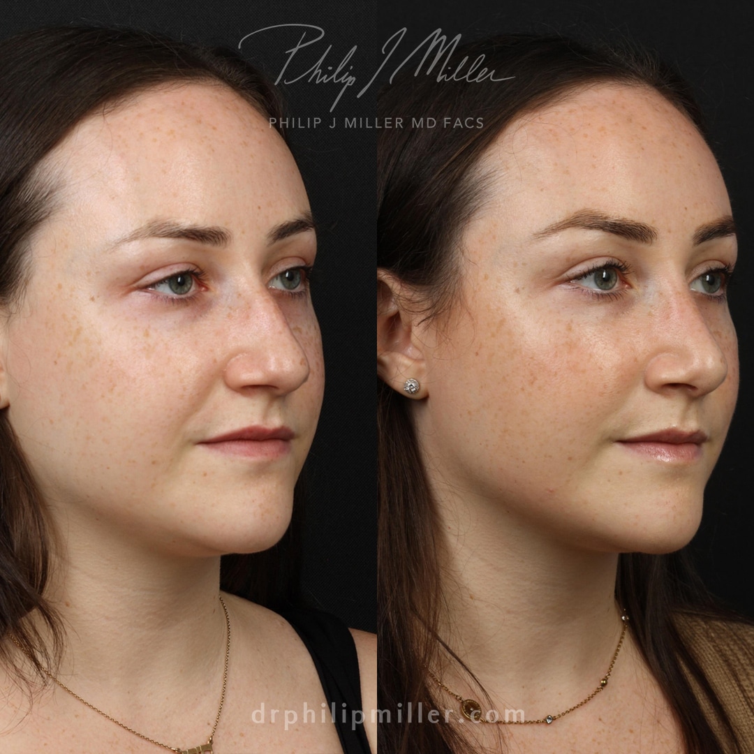 Rhinoplasty to remove bump and straighten nasal bridge of female patient by Dr. Miller. After surgery, bridge is straighter and patient's facial profile is improved.