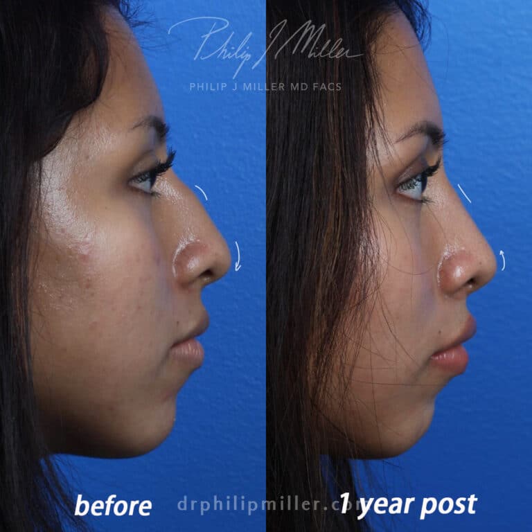 Rhinoplasty to reshape nasal bridge and tip of a female patient by Dr. Miller. Surgery straightens nasal bridge and turns up tip slightly to improve patient's facial profile.