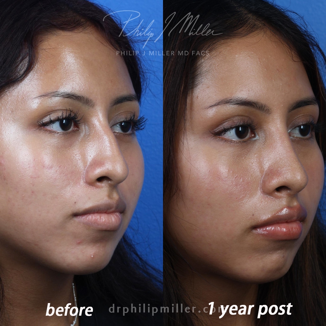 Rhinoplasty to reshape nasal bridge and tip of a female patient by Dr. Miller. Surgery straightens nasal bridge and turns up tip slightly to improve patient's facial profile.