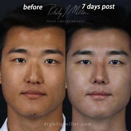 Rhinoplasty to straighten the nasal bridge of a male patient by Dr. Miller