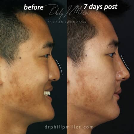 Rhinoplasty to straighten the nasal bridge of a male patient by Dr. Miller