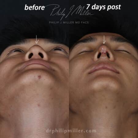 Rhinoplasty to straighten the nasal bridge of a male patient by Dr. Miller