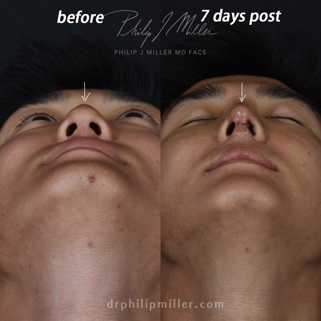Rhinoplasty to straighten the nasal bridge of a male patient by Dr. Miller. After surgery, the septum is straighter and the patient's profile is improved.