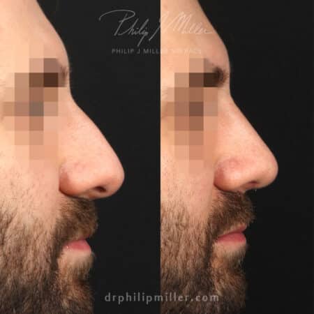 Septorhinoplasty to improve the nasal bridge of a male patient by Dr. Miller