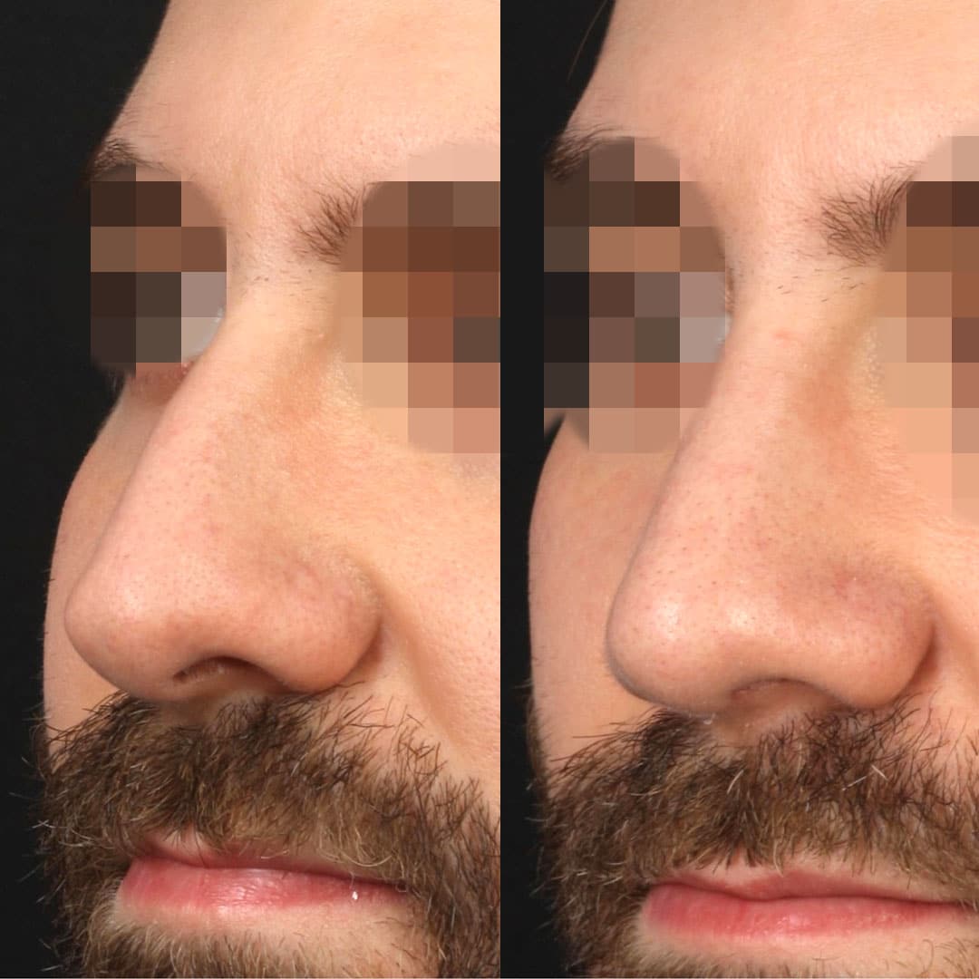 Septorhinoplasty to improve the nasal bridge of a male patient by Dr. Miller. After surgery, nasal bridge is straighter to enhance patient's facial profile.
