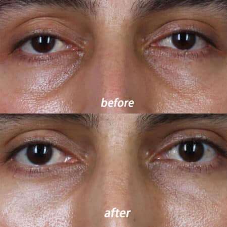 Tear trough filler to refresh the area under the eyes by Dr. Miller