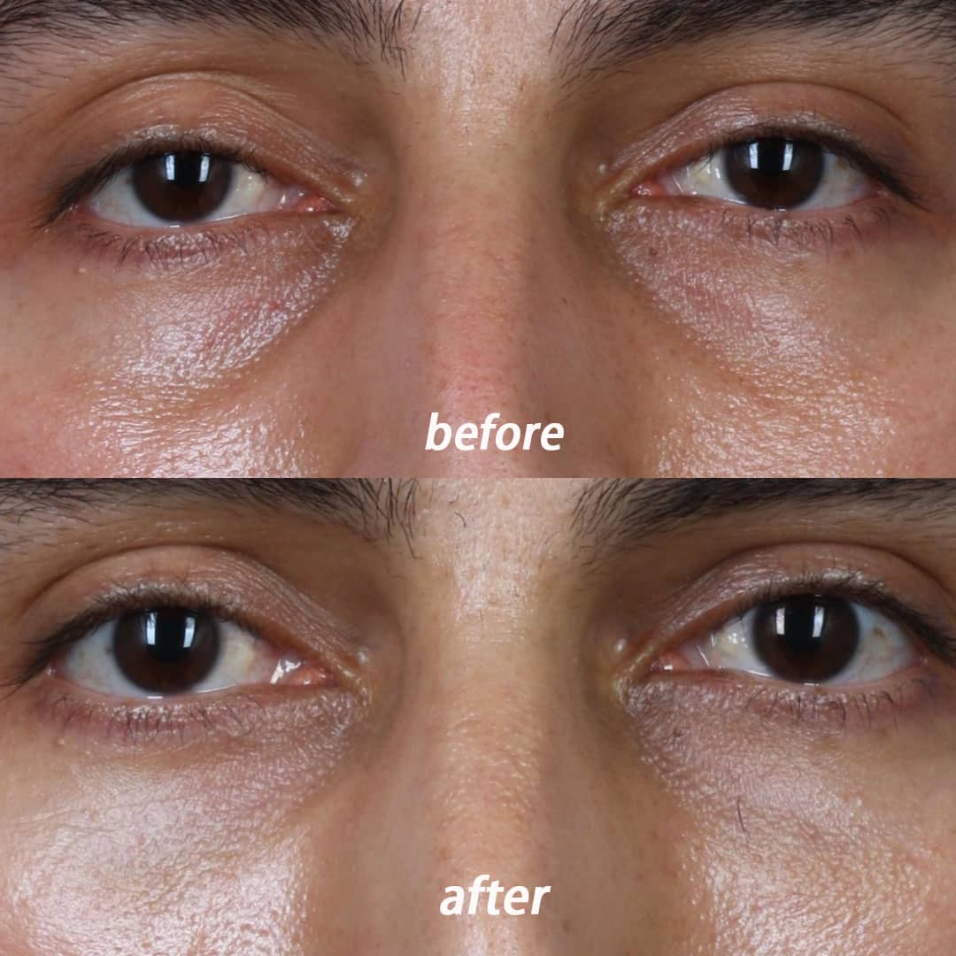 Tear trough filler to refresh the area under the eyes by Dr. Miller. After treatment, discoloration is reduced and the eyes look younger.