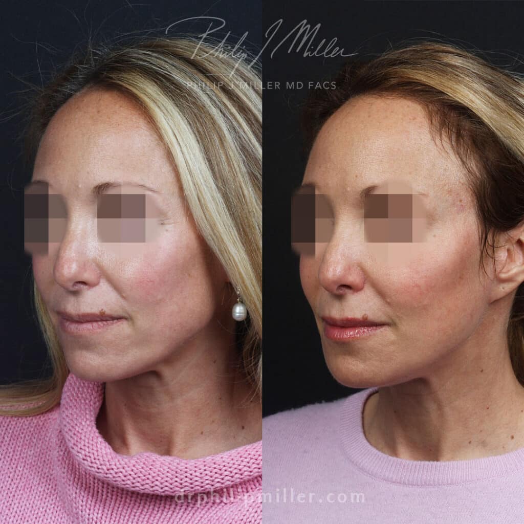 Side-by-side portrait of a woman with pixelated eyes, showing before (left) and after (right) cosmetic treatment; left image in a pink sweater, right image in a light purple top.
