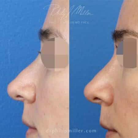 Micro Rhinoplasty by Dr. Miller