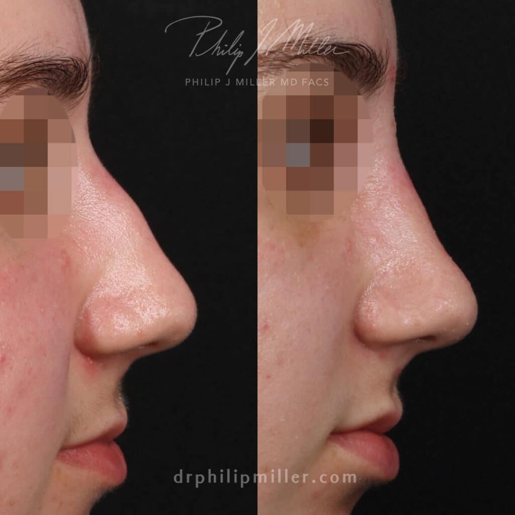 Microrhinoplasty before and after photos of a female patient