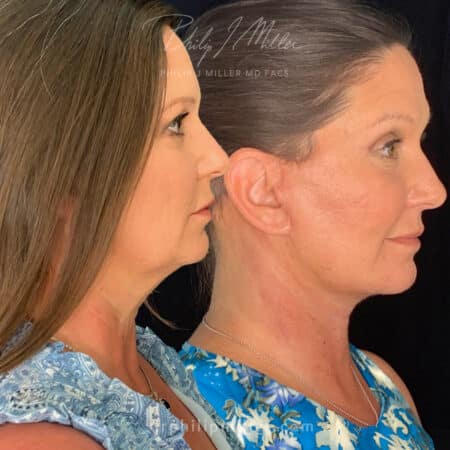 Facelift to rejuvenate the face and tighten jawline by Dr. Miller – 3 weeks post-op