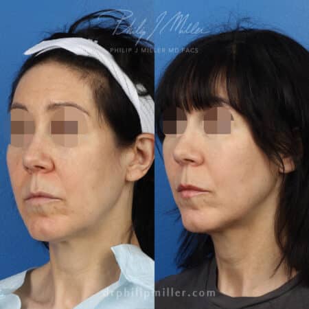 Female Microlift to tighten jawline by Dr. Miller