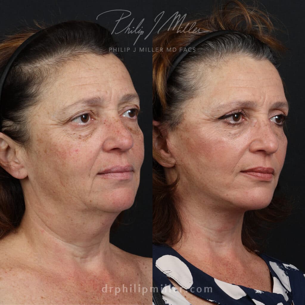 Facelift to rejuvenate the appearance of a female patient by Dr. Miller. After surgery, jawline is more defined and jowls are tighter.