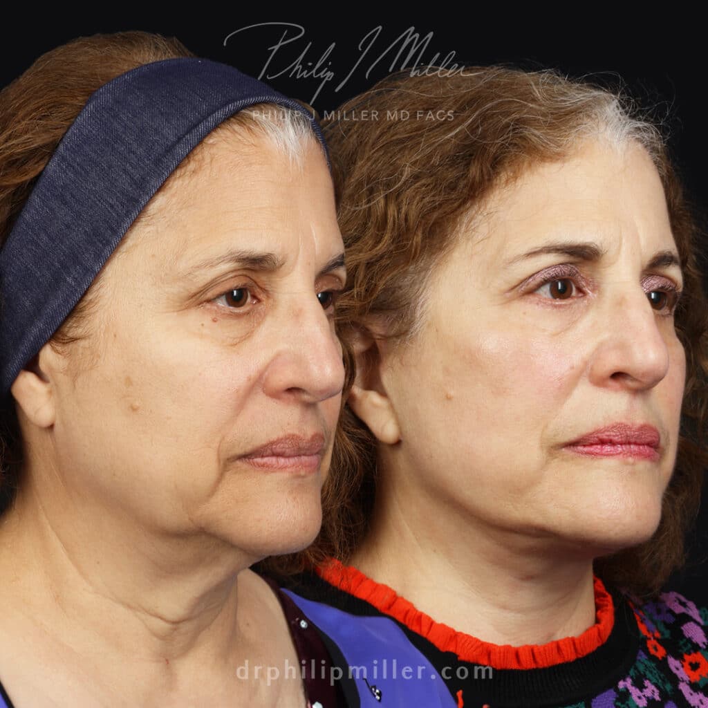 Facelift to rejuvenate appearance of a female patient by Dr. Miller. After surgery, the jawline is tighter and cheekbones appear higher.