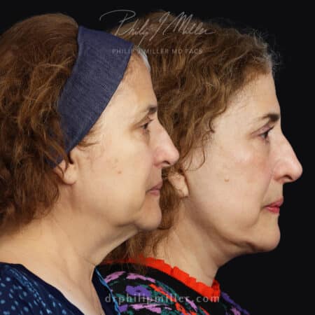 Female facelift to rejuvenate appearance by Dr. Miller