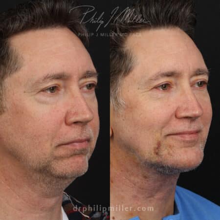 Male facelift to rejuvenate appearance and tighten neck by Dr. Miller