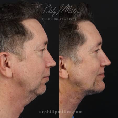 Male facelift to rejuvenate appearance and tighten neck by Dr. Miller