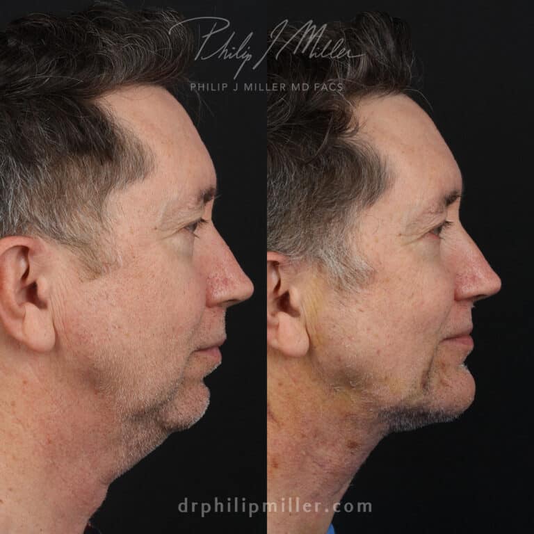 Facelift to rejuvenate the appearance of a male patient by Dr. Miller. After surgery, jawline is more defined and jowls are tighter.