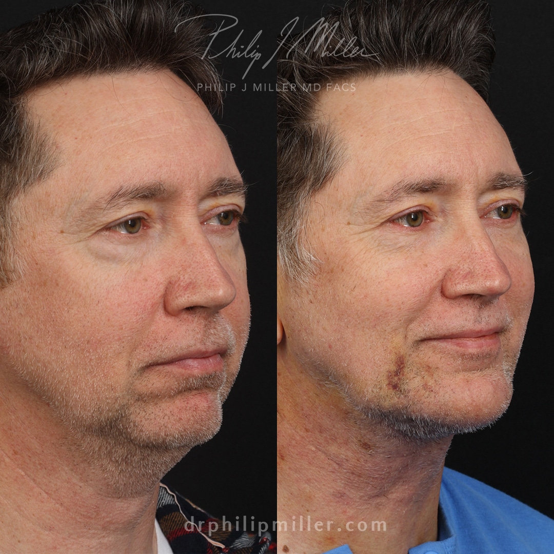 Facelift to rejuvenate the appearance of a male patient by Dr. Miller. After surgery, jawline is more defined and jowls are tighter.