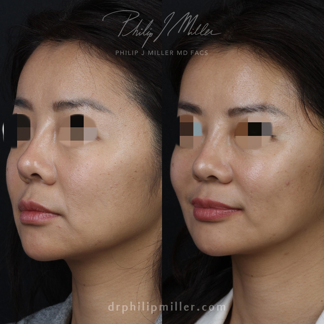 Microlift to rejuvenate face of female patient by Dr. Miller. After surgery, the jawline is tighter and cheekbones appear higher.