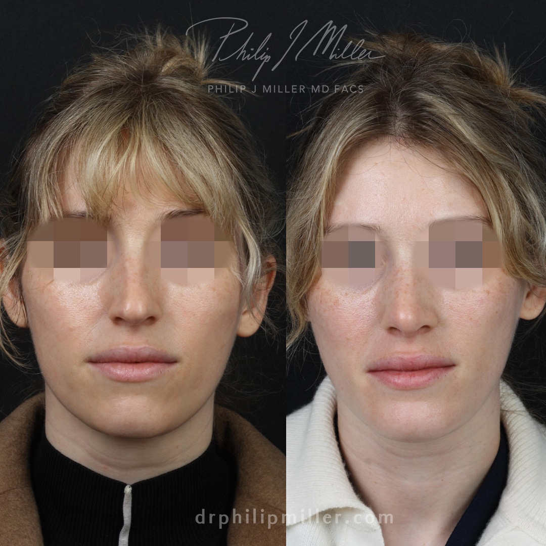 Rhinoplasty and chin implant to improve facial profile by Dr. Miller. After surgery, the nasal tip is slightly lifted and the chin is more defined.