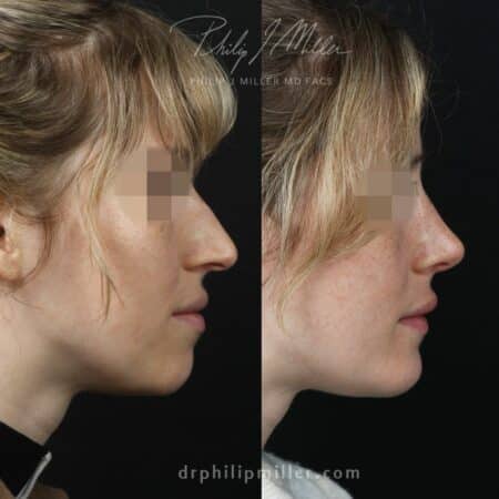 Rhinoplasty and chin implant to improve facial profile by Dr. Miller