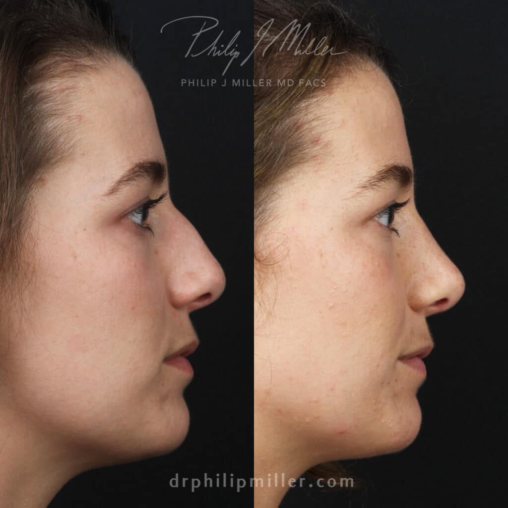 Rhinoplasty to straighten the bridge of the nose of a female patient by Dr. Miller. After surgery, her nose has a smoother slope down the bridge.