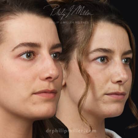 Female Rhinoplasty to straighten the bridge by Dr. Miller