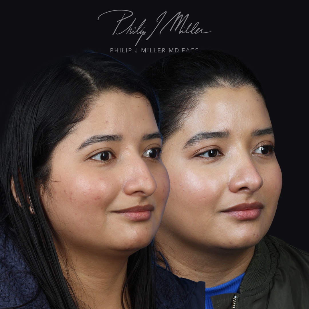 Rhinoplasty to remove nasal hump and refine tip of female patient by Dr. Miller. After surgery, her nasal bridge is straight and the tip is slightly lifted.