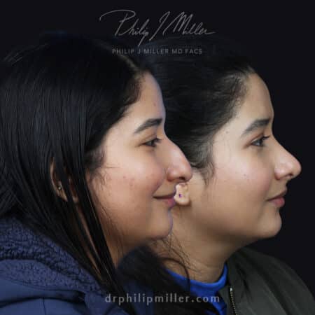 Female rhinoplasty to remove nasal hump and refine tip by Dr. Miller