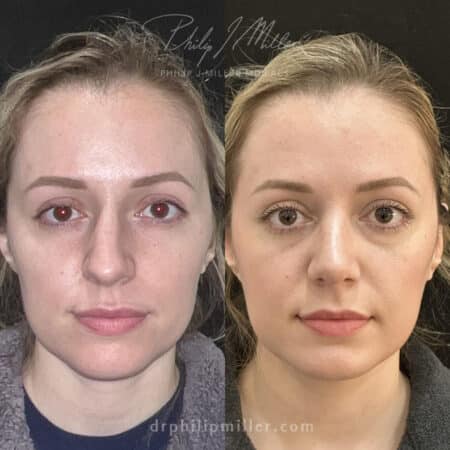 Female Rhinoplasty to straighten nasal bridge by Dr. Miller