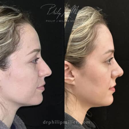 Female Rhinoplasty to straighten nasal bridge by Dr. Miller