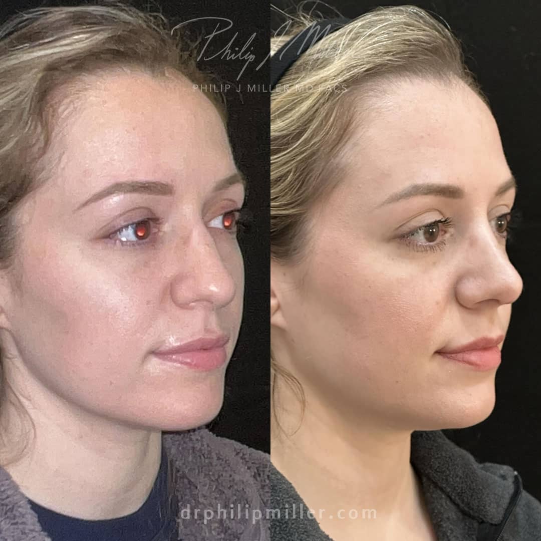 Rhinoplasty to straighten the nasal bridge of a female patient by Dr. Miller. After surgery, her nose appears more straight and has a smoother slope.