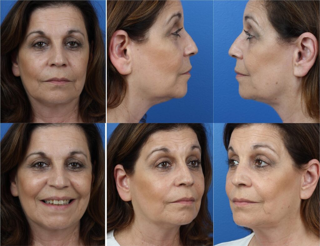 patient from new york before undergoing smas facelift with dr miller