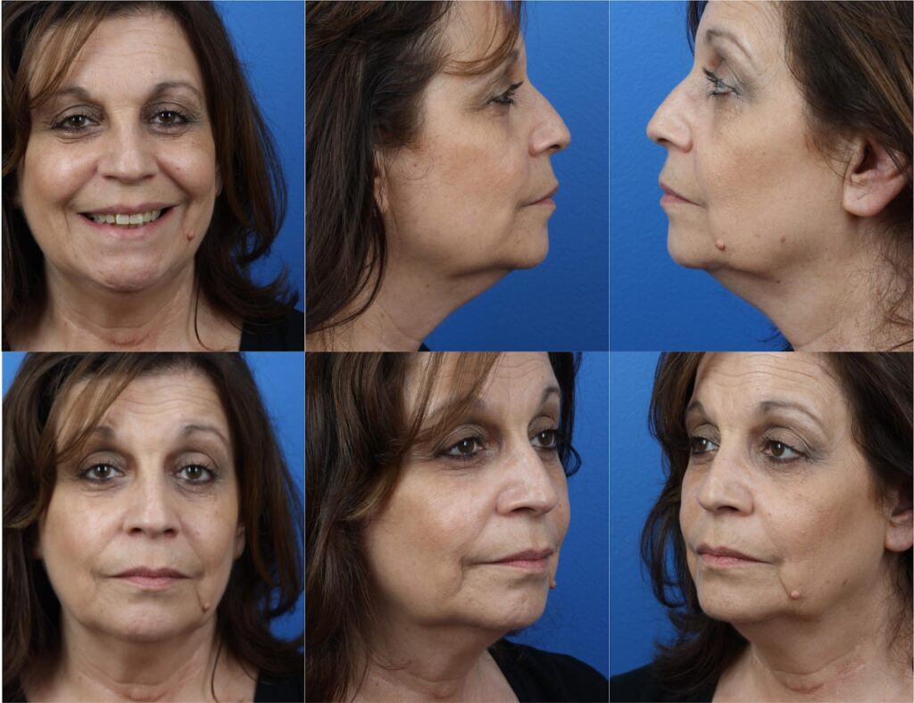 patient from New York before and after undergoing blepharoplasty and facial liposuction procedures