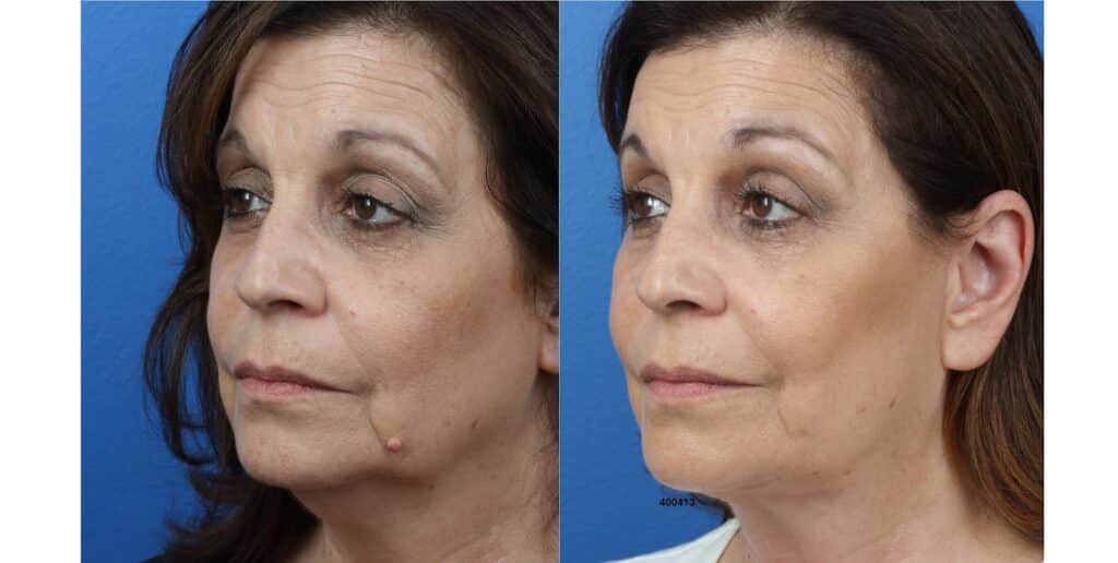 facelift before and after