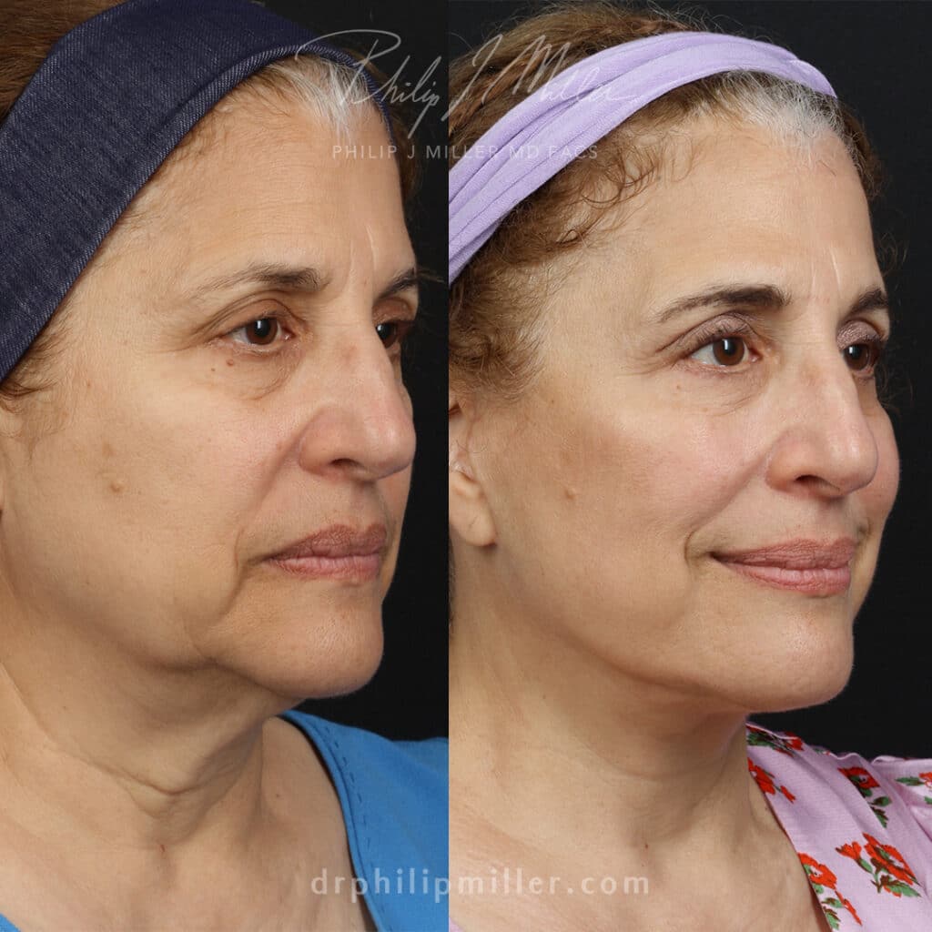 Deep plane face lift to refresh and take years off patient's appearance by Dr. Miller.