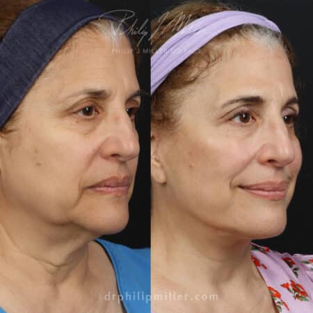 Deep Plane Facelift for Dramatic Facial Rejuvenation Before and After