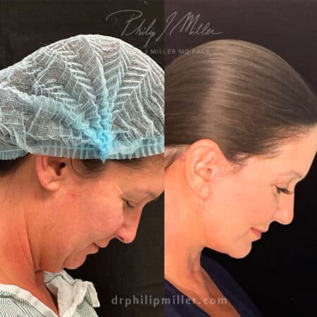 Combined facelift and neck lift to lift and tighten the skin around the face and neck, unveiling a rejuvenated and naturally youthful appearance by Dr. Miller.