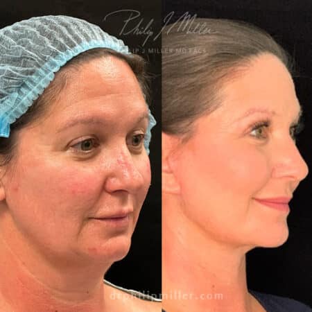 Facelift and Neck Lift to Take Years Off Patient’s Appearance Before and After